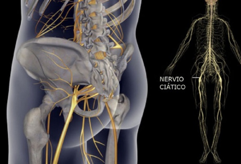 Cómo aliviar el dolor del nervio ciático